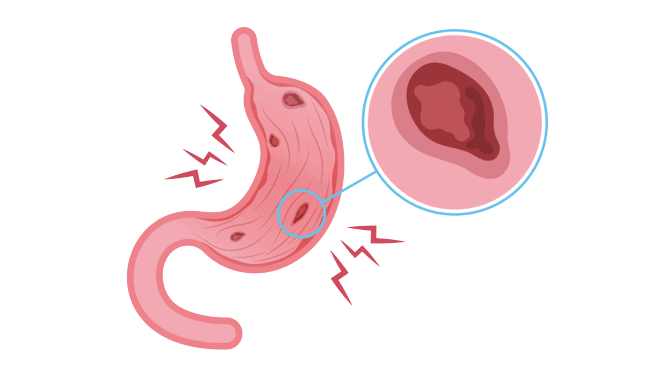 Life insurance with GERD in Canada